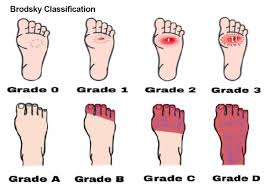 Image result for IDSA Diabetic Foot Wound Classification