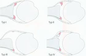 The shape of the acromion had been initially divided into three types (which was known as the bigliani classification) 3, to which a fourth has been added 2. Https Silo Tips Download Schulter Orthopdie Ws 2011 2012 Ursachen Von Schulterschmerzen Erkrankungen Der