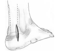 Haglund's deformity is characterized as an enlarged prominence of the superior aspect of the posterior calcaneus, which can cause painful inflammation within the retrocalcaneal bursa and anterior surface. The Diagram Shows The Lateral Approach For Haglund S Procedure Download Scientific Diagram