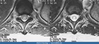 Image result for Myelitis