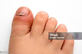 Image result for Akutní zánět nehtového lůžka