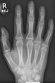Image result for Wrist XRay