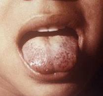 Deficiencies in calcium, vitamin d and vitamin e can cause white patches on the skin. Scurvy Wikipedia