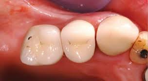 Image result for Occlusal