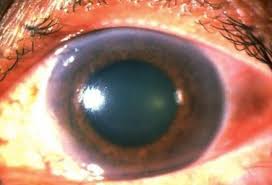 Image result for Acute Red Eye