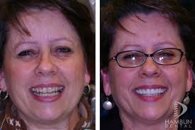 Hamblin Dental Implant and Aesthetic, 10011 S Centennial Pkwy, Ste 540,  Sandy, UT 84070, US