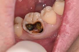 虫歯 黒い 点 消え た