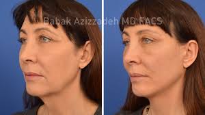 With botox injectable, juvederm and dermal fillers, you can get rid of those pesky wrinkles quickly, leaving you with a youthful complexion that looks natural. Brow Lift Forehead Eyebrow Lift Surgery Beverly Hills Center