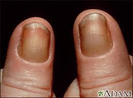 Symptoms develop slowly and in advanced stages include anorexia, nausea, vomiting, stomatitis, dysgeusia, nocturia, lassitude, fatigue, pruritus, decreased mental acuity, muscle twitches and cramps, water. Nail Abnormalities Information Mount Sinai New York