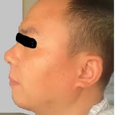 Endoscopic image of the larynx at the end of 6 cycles of chemotherapy.