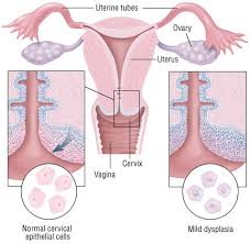 The cancer of the cervix is most common in women over the age of 30. Cervical Cancer Guide Causes Symptoms And Treatment Options