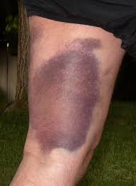 An instance of physical damage to a person's hamstring | meaning, pronunciation, translations and examples. Hamstring Strain What Is It What Can I Do About It Physioroom Blog