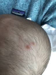 Image result for sores on the head in children