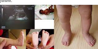 Treatment of idiopathic clubfoot has evolved over the years through different changes where surgery and conservative treatment have been competing each other. Figure 4 From The Treatment Of Congenital Clubfoot By Ponseti Method Semantic Scholar