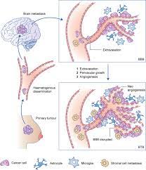 Signs and symptoms of metastasis. Treatment Strategies For Breast Cancer Brain Metastases British Journal Of Cancer