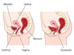 Image result for Urethral Prolapse