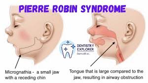 Pierre Robin Syndrome Causes Characteristic Features And Management Dentistry Explorer