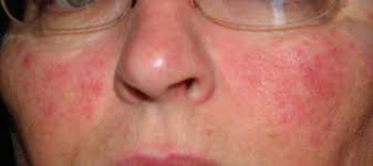 Image result for 5 signos de que eres deficiente en Vitaminas