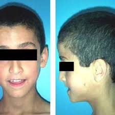 Patient with BRRS. Note macrocephaly, ocular hypertelorism, long...