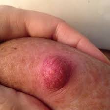You can also use your hands to pressure the milk out. Milk Blister Photo Breastfeeding Forums What To Expect