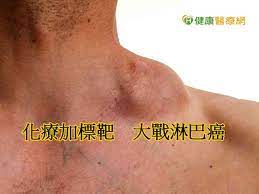 哪個細胞突變了？ b細胞型：較常見。罹患淋巴癌的犬貓中， 約有八成的狗和六成的貓是屬於此類型 。 t細胞型：雖然比例較低，但此類型的淋巴癌在治療上比較困難。 腫瘤長在哪？ èº«ä¸Šå‡ºç¾ä¸æ˜Žè…«ç˜¤å°å¿ƒææ˜¯æ·‹å·´ç™Œ å¥åº·é†«ç™‚ç¶² è‰¯é†«å¥åº·ç¶²