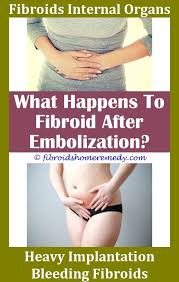 Anterior Fibroid Fibroid Surgery Fibroid Uterus Uterine