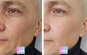 ‫عکس قبل و بعد از پی آر پی صورت؛ مقایسه تاثیرات درمان و مزایا • دیجی‌کالا مگ‬‎