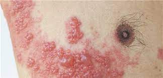 Die windpocken und die vor allem ältere menschen quälende gürtelrose haben etwas gemeinsam: Bei Herpes Zoster Schmerztherapie Von Anfang An