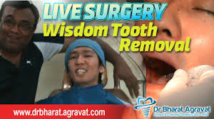 This page gives price estimates of how much you might pay a general dentist to remove one or more of your teeth (arranged by what would be an average cost for taking out the two top wisdom teeth only? Wisdom Tooth Surgery Cost Reviews Famous Best Cosmetic Implants Dentist Ahmedabad India