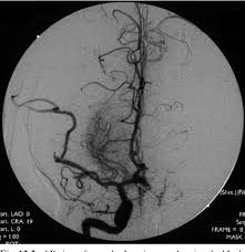 The chance of developing a permanent stroke (weakness, numbness or paralysis) as the result of a cerebral angiogram is approximately 0.5%. Figure 12 2 From Stroke And Diabetes Mellitus Semantic Scholar