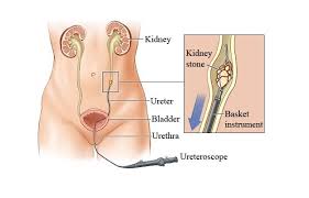 Advantages Of Kidney Stone Removal Without Surgery Urolife Stone Hospital