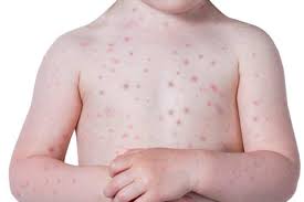 Selain campak, bintik demam berdarah juga dapat disalahartikan dengan bintik cacar air. Beza Campak Dan Chicken Pox Ini Cara Untuk Kenalpasti Perbezaannya