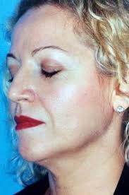 Barry Weintraub, MD, FACS