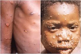 179 monkeypox premium high res photos browse 179 monkeypox stock photos and images available or search for monkeypox virus to find more great stock photos and pictures. First Case Of Monkeypox In Singapore 6 Things To Know About The Virus Health News Top Stories The Straits Times