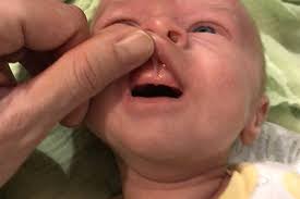 Image result for Neonatal Teeth