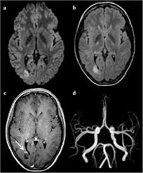 Be part of the world's largest community of book lovers on goodreads. Magnetic Resonance Imaging Of Arterial Stroke Mimics A Pictorial Review Insights Into Imaging Full Text