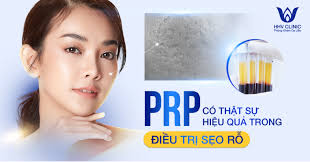 PRP TRỊ SẸO RỖ SẸO LÕM CÓ AN TOÀN & HIỆU QUẢ KHÔNG?