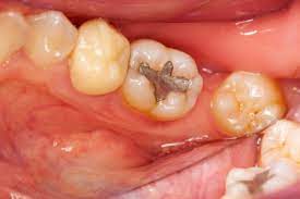What Should I Do If My Filling Falls Out All Needs Dental