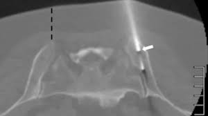 Image result for Bone Marrow Exam