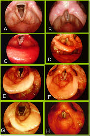 Oral cancer can affect the mouth including the gums, lips, tongue, mouth's roof, and floor and the inner cheeks. Radiotherapy Alone For Early Stage Squamous Cell Carcinoma Of The Larynx And Hypopharynx International Journal Of Radiation Oncology Biology Physics
