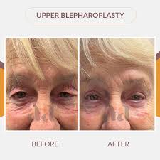 Look at these results of my patient who recently came in with some concerns  around her upper eyelids.Thanks to my patient who was happy for me to share  her before and after