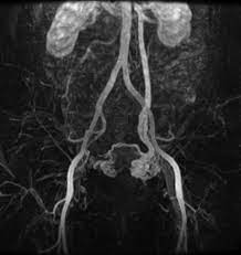 Options For Pelvic Congestion Syndrome Clinical Advisor