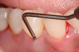 9 Natural Ways To Treat Periodontal Disease Thehealthology