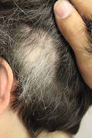 It is usually seen as an autoimmune disease and is associated with other such diseases. Vogt Koyanagi Harada Syndrome Association With Alopecia Areata