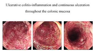Image result for Ulcerative Colitis
