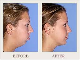 What Is Chin Surgery Chin Surgery Or Mentoplasty Is A Surgical Procedure To Reshape The Chin Either By Enh Orthognathic Surgery Chin Implant Plastic Surgery