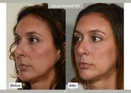 More often than not patients who request tear trough filler need additional  support to restore volume to the cheeks just below. . By adding volume to  the area of the deep medial
