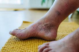 Image result for diabetic toes