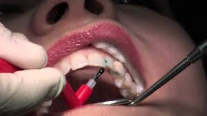How do dentists fix cavities in the front teeth? Composite Fillings Youtube