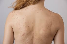 Maybe you would like to learn more about one of these? Jerawat Belakang Badan Mudah Dan Murah Dirawat Curio Spa